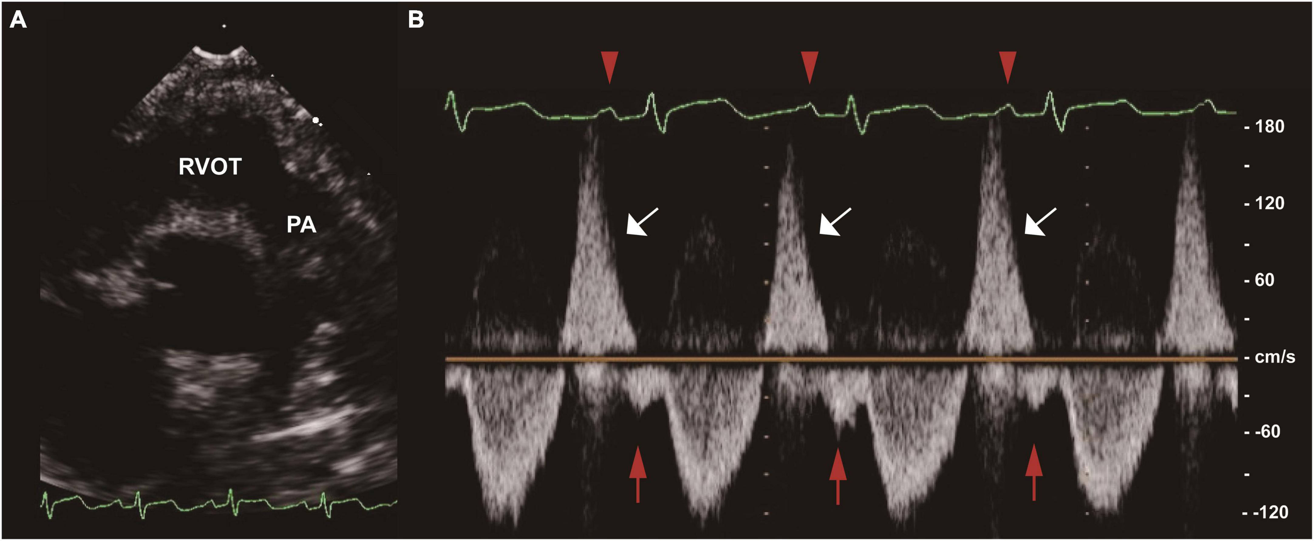 End-diastolic forward flow in repaired tetralogy of Fallot: Mid-term outcomes from a single center